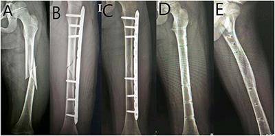 Operative Choice for Length-Unstable Femoral Shaft Fracture in School-Aged Children: Locking Plate vs. Monolateral External Fixator